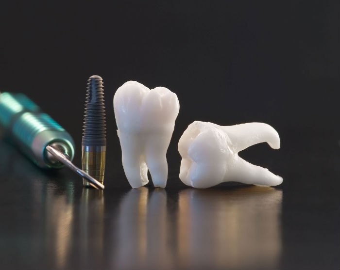 Five Benefits of Dental Implants in Wall NJ